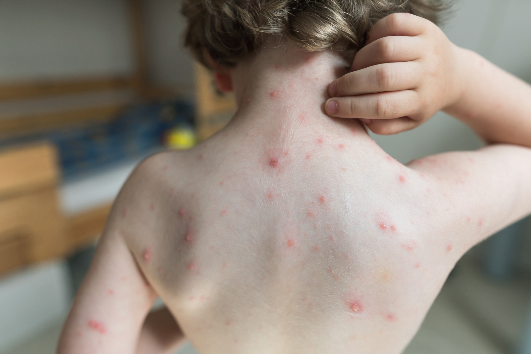 rashes treatment NJ