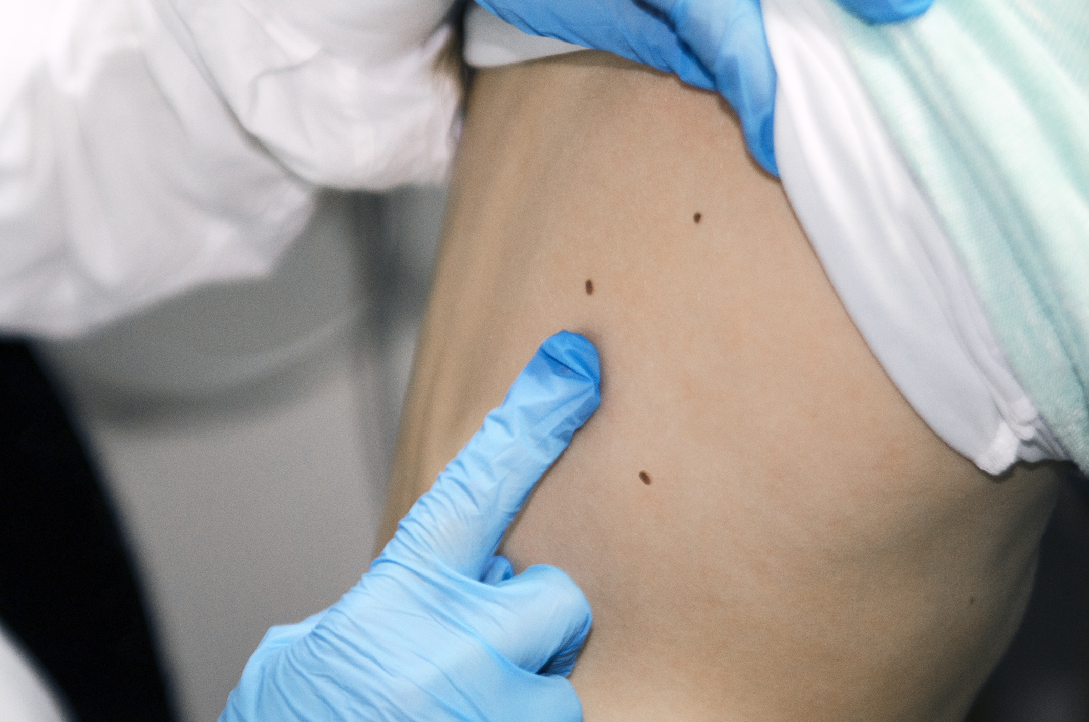 mole check robbinsville NJ
