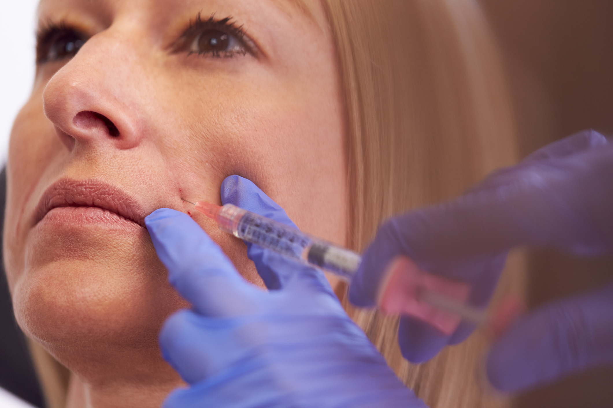 Cosmetic Fillers