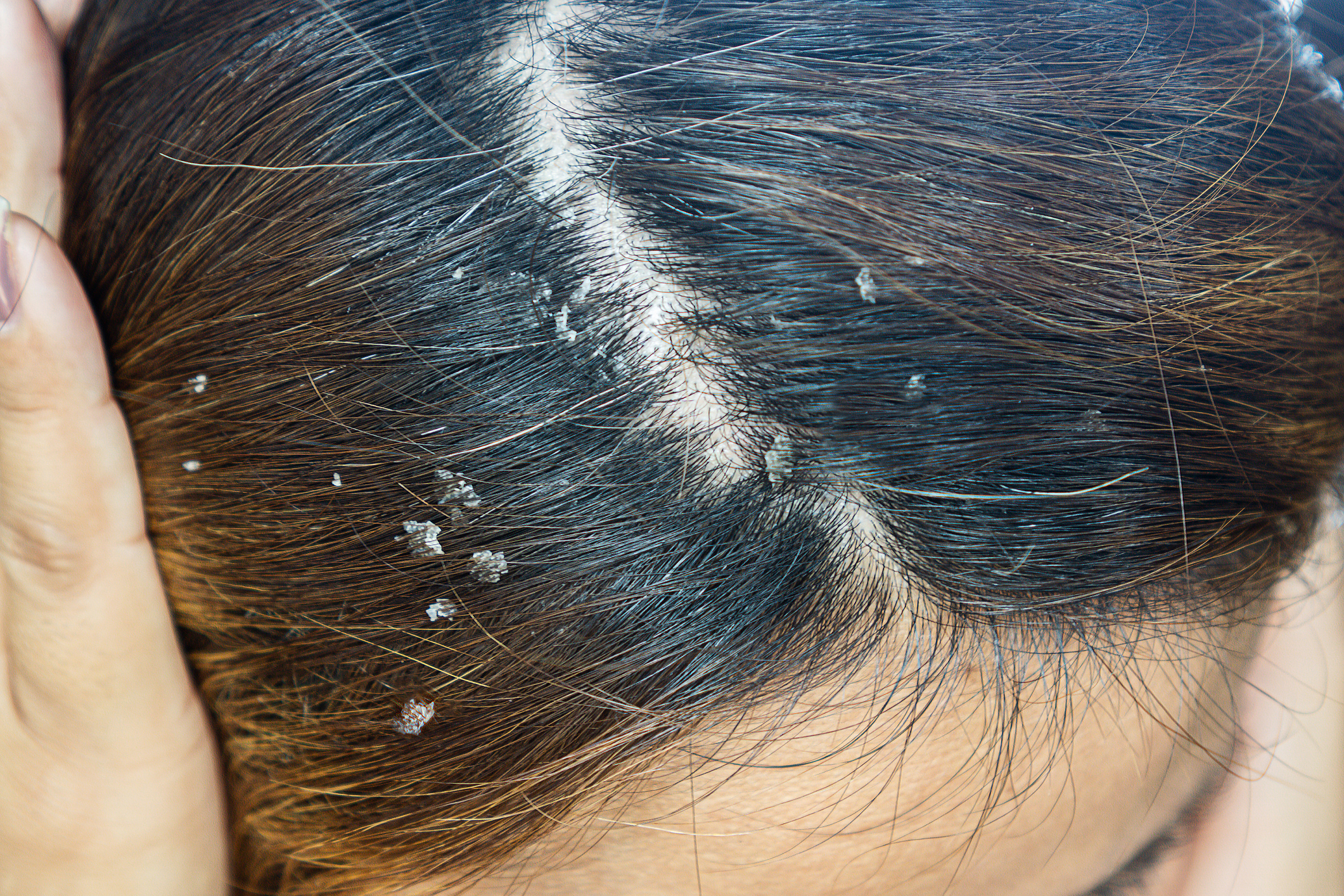 Seborrheic dermatitis treatment robbinsville NJ