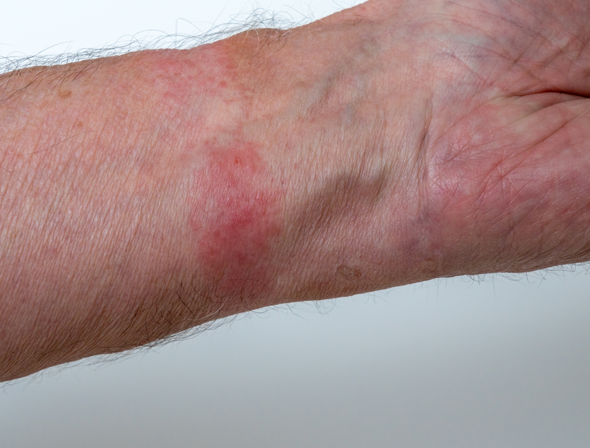 Contact Dermatitis Aura Dermatology