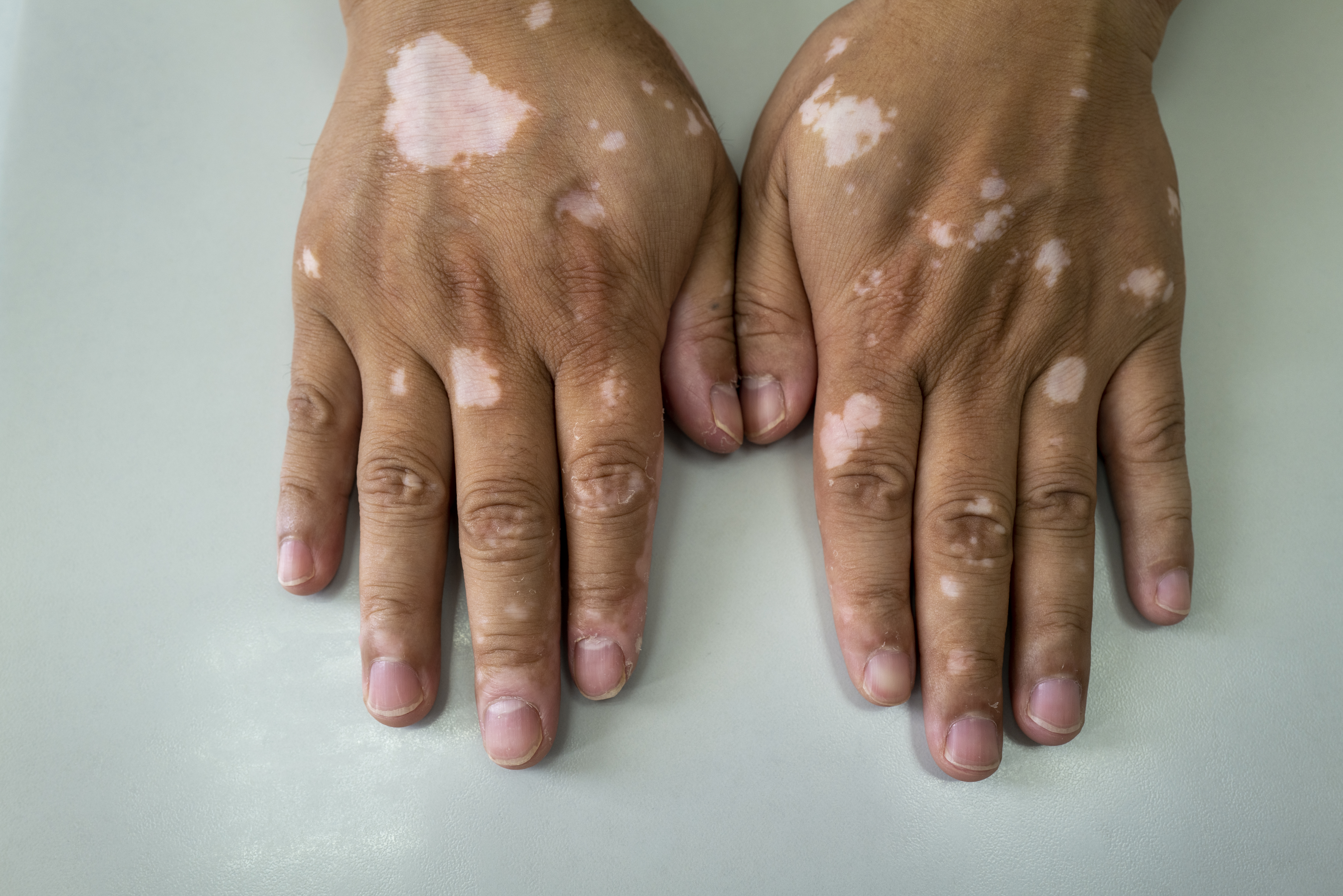 Vitiligo