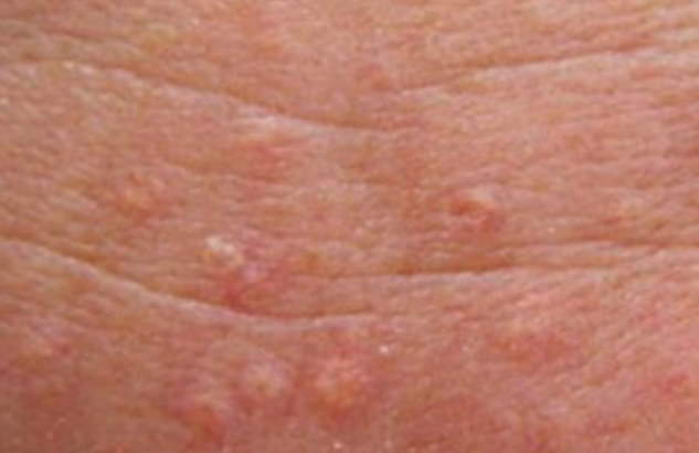 sebaceous hyperplasia treatment in New Jersey