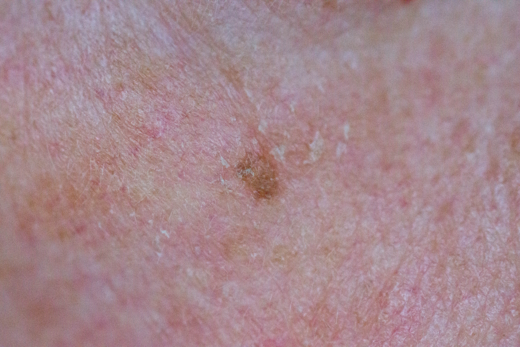 Seborrheic Keratosis treatment NJ