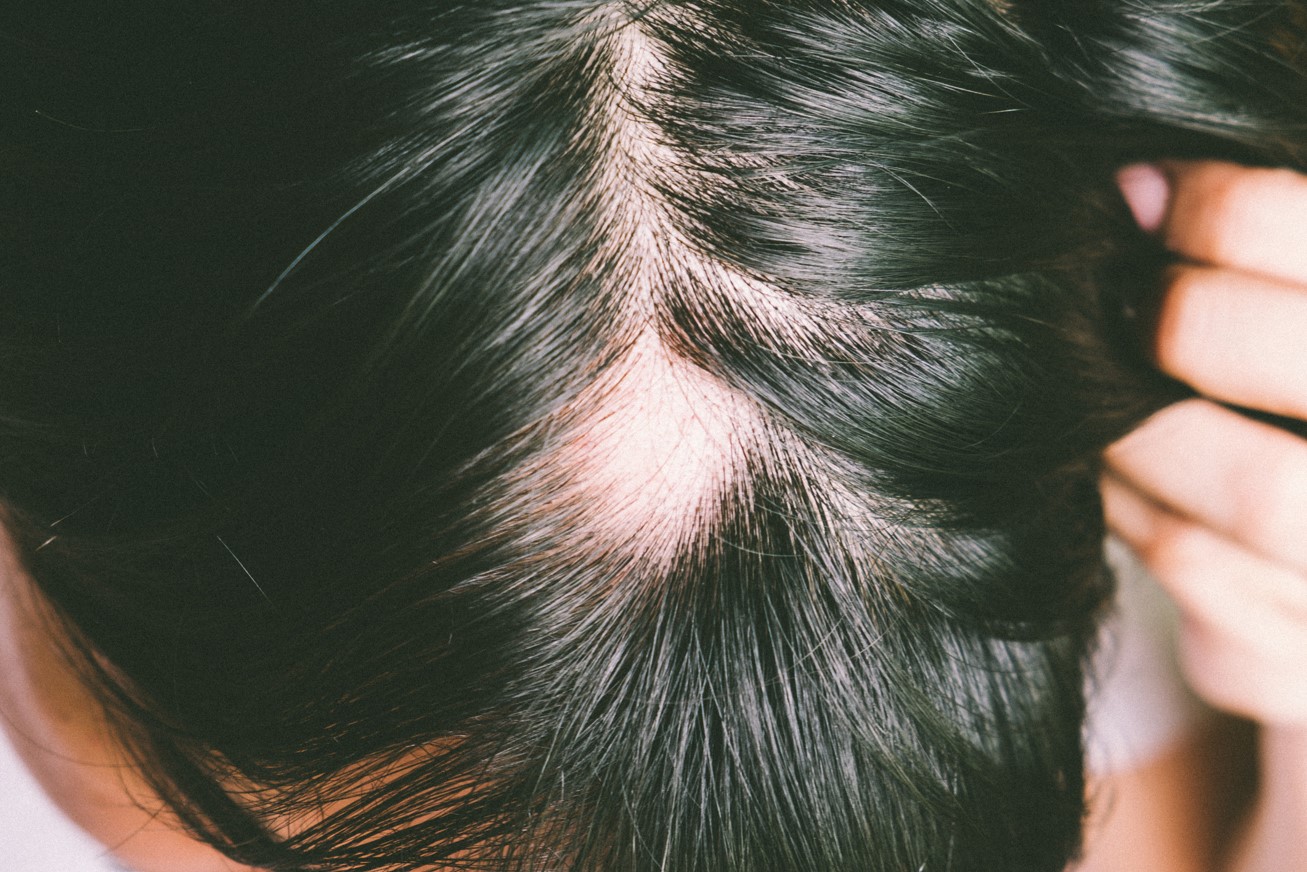 alopecia treatment
