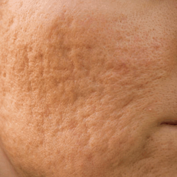 Acne Scar Combo Treatment