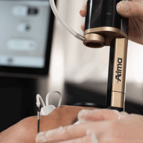 Alma Co2 Hybrid Laser